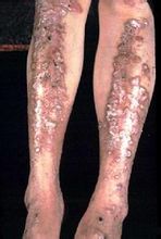 大疱性表皮松解 大疱性表皮松解