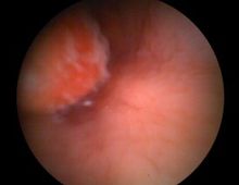 胃神经官能症(图4) 胃神经官能症(图4)